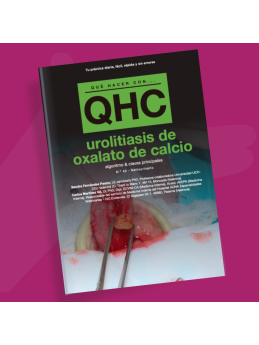 Qué Hacer Con... Urolitiasis de oxalato de calcio