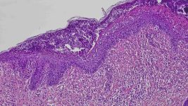 16a- Histológica cutánea de un perro con leishmaniosis, con dermatosis pustular con acantolisis leve, dermatitis perivascular-periadnexal granulomatosa.