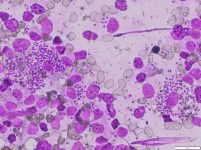 3 - Amastigotes de leishmania intracelulares en un nódulo linfático de un perro con leishmaniosis.