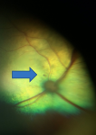 5.3.hemorragia intraretinal