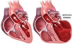 Cardiomiopatía dilatada