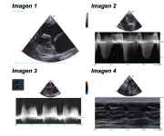 Ecocardiografia con dilatación auricular severa