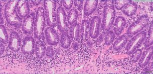 Figura 2 Inflamacioěn linfoplasmocitaria y eosinofiělica en ileon de paciente con IBD. Foto cortesiěa de IDEXX